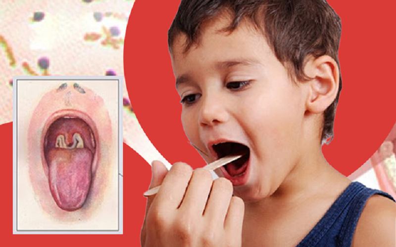 Triệu chứng điển hình của bệnh tăng bạch cầu đơn nhân nhiễm trùng bao gồm sốt, viêm họng và nổi hạch